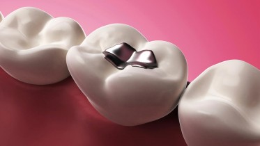 Mercury-Tooth-Filling-Teeth